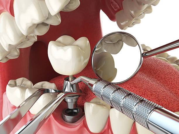 Best Emergency Broken Tooth Repair in Simpsonville, SC